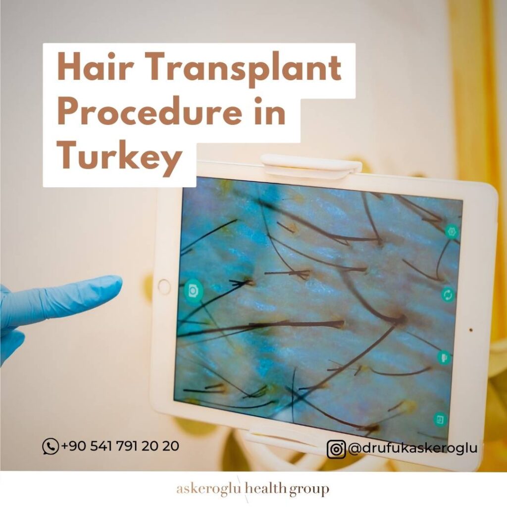 Hair Transplant Procedure Turkey