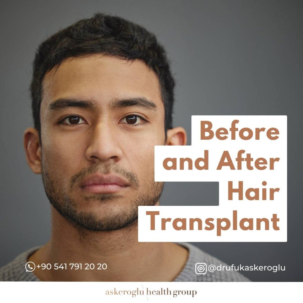 Before After Hair Transplant