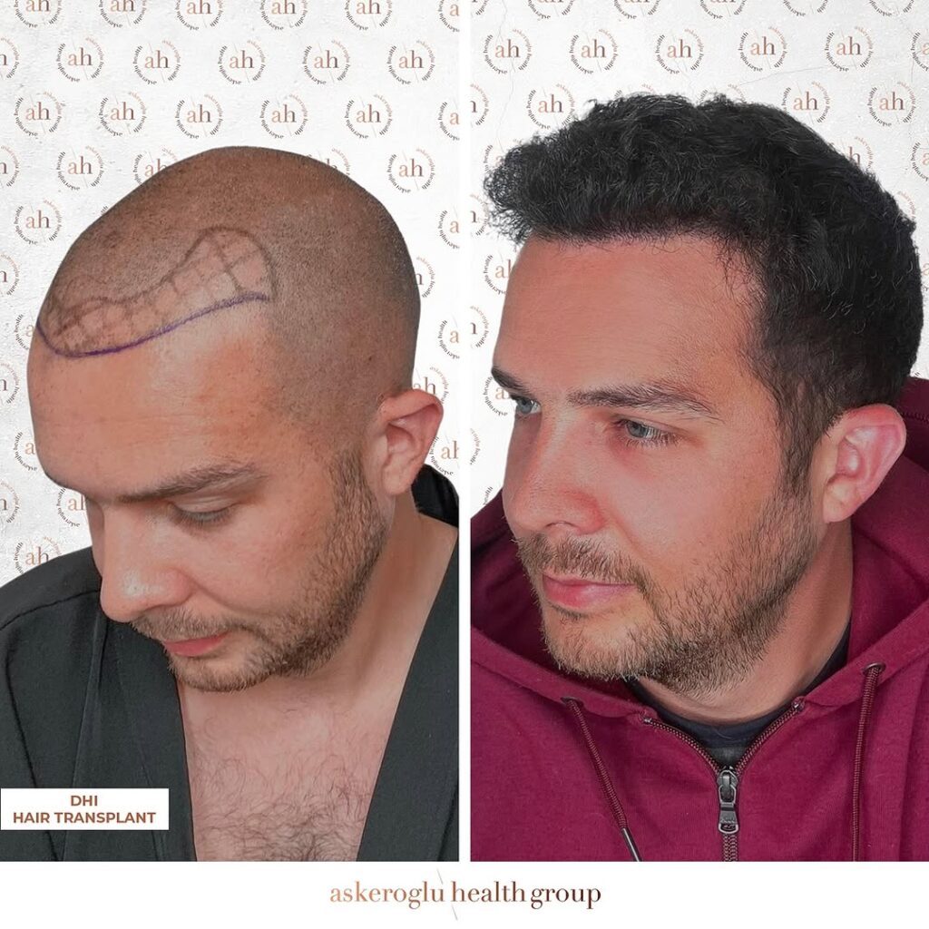 Hair Transplant Turkey