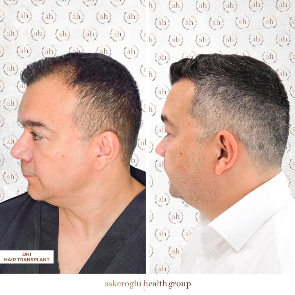 Hair Transplant Turkey