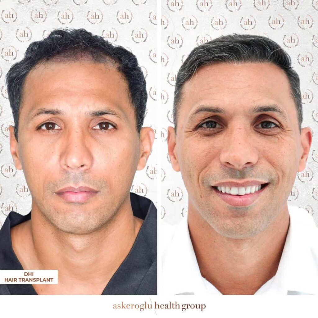 Hair Transplant Turkey