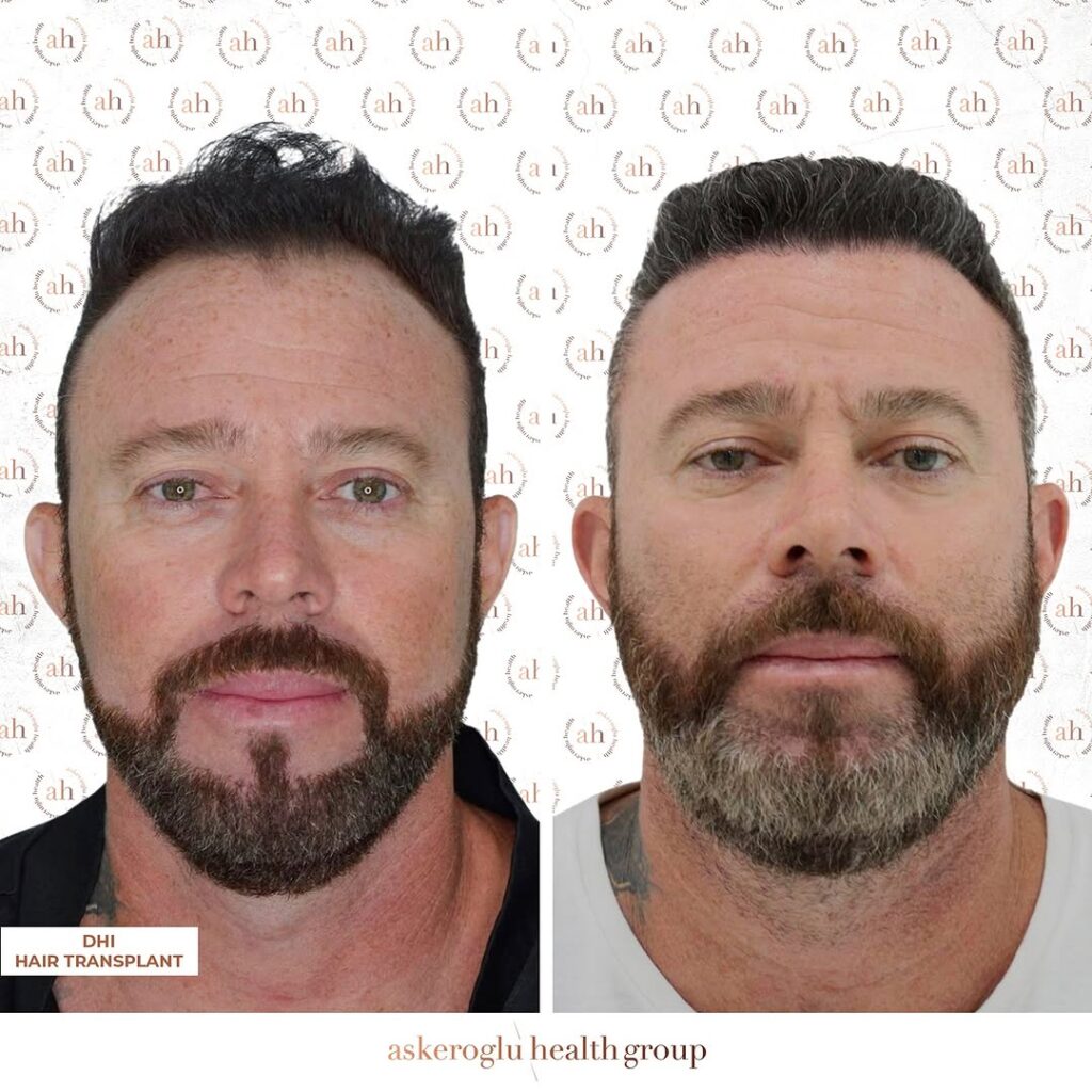 Hair Transplant Turkey