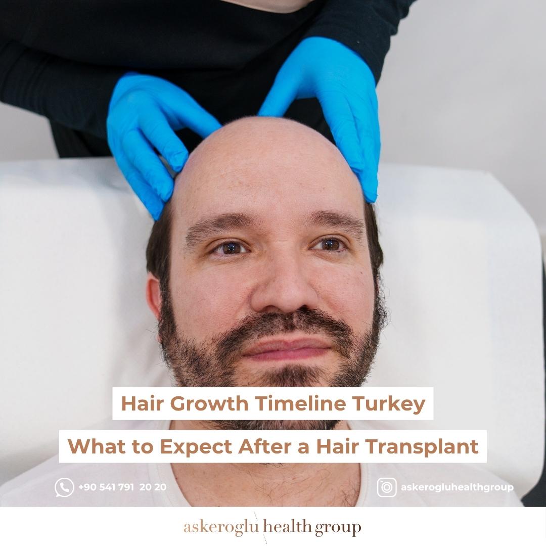 Hair Growth Timeline Turkey
