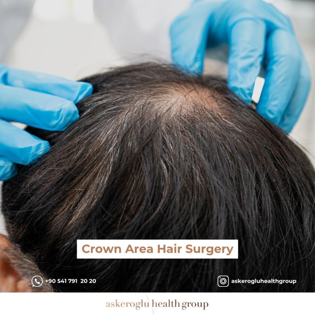 Crown Area Hair Surgery