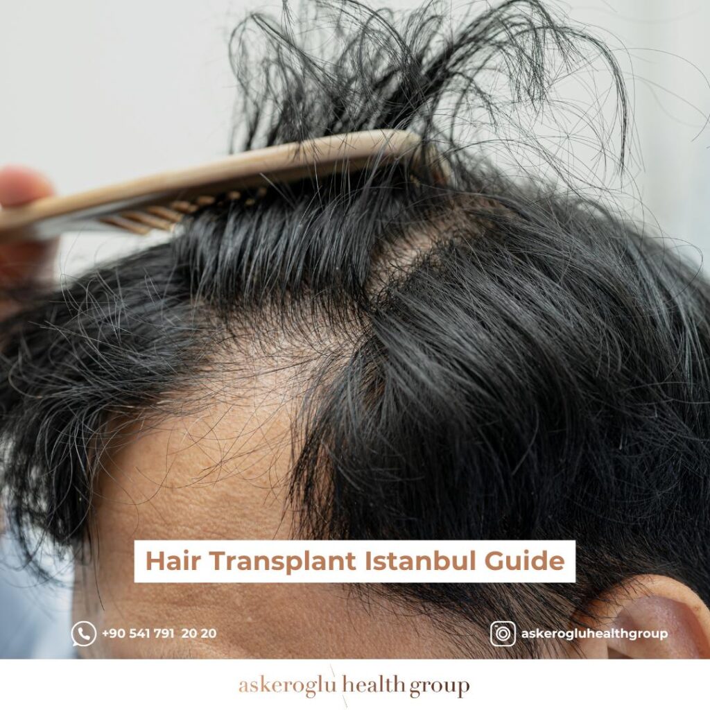 Hair Transplant Istanbul Guide