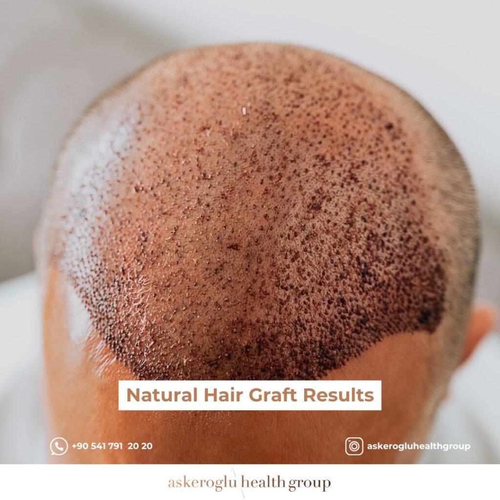 Natural Hair Graft Results