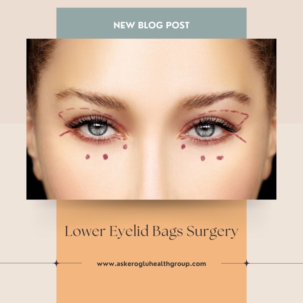 Lower Eyelid Bags Surgery