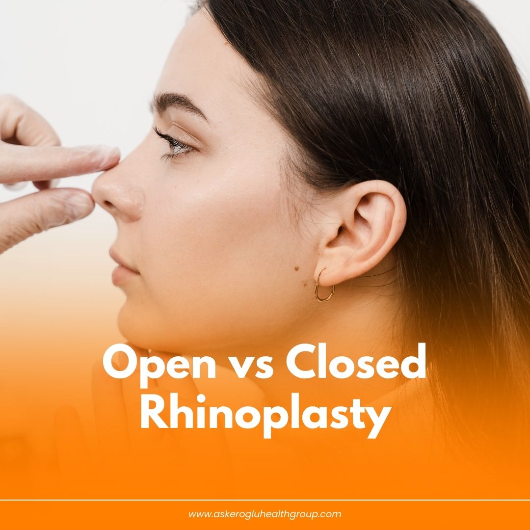 Open vs Closed Rhinoplasty