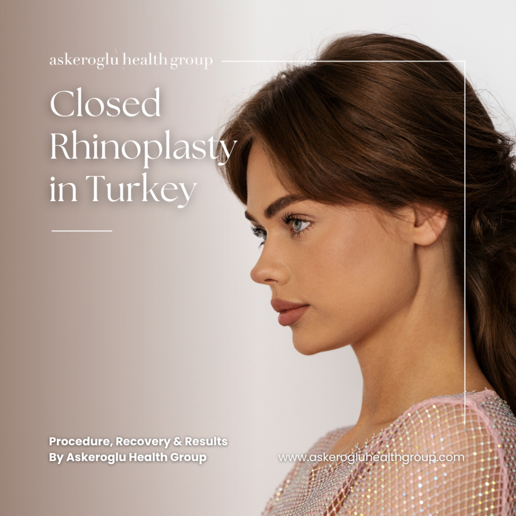 Closed Rhinoplasty in Turkey